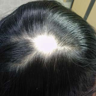 Alopecia